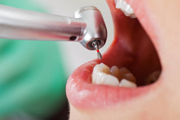 Best Emergency Treatment for Toothache in Malad City, ID
